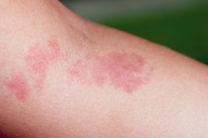 emangioma