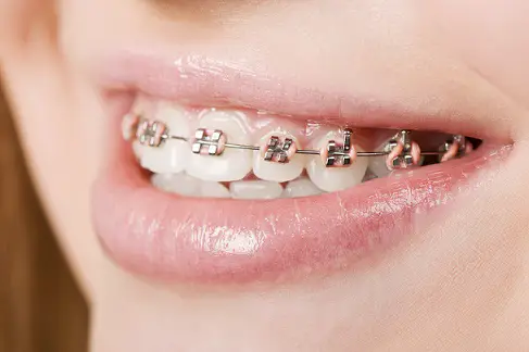 Giovane donna con apparecchio per denti
