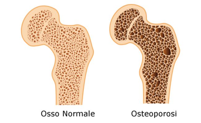 osteoporosi diagnosi