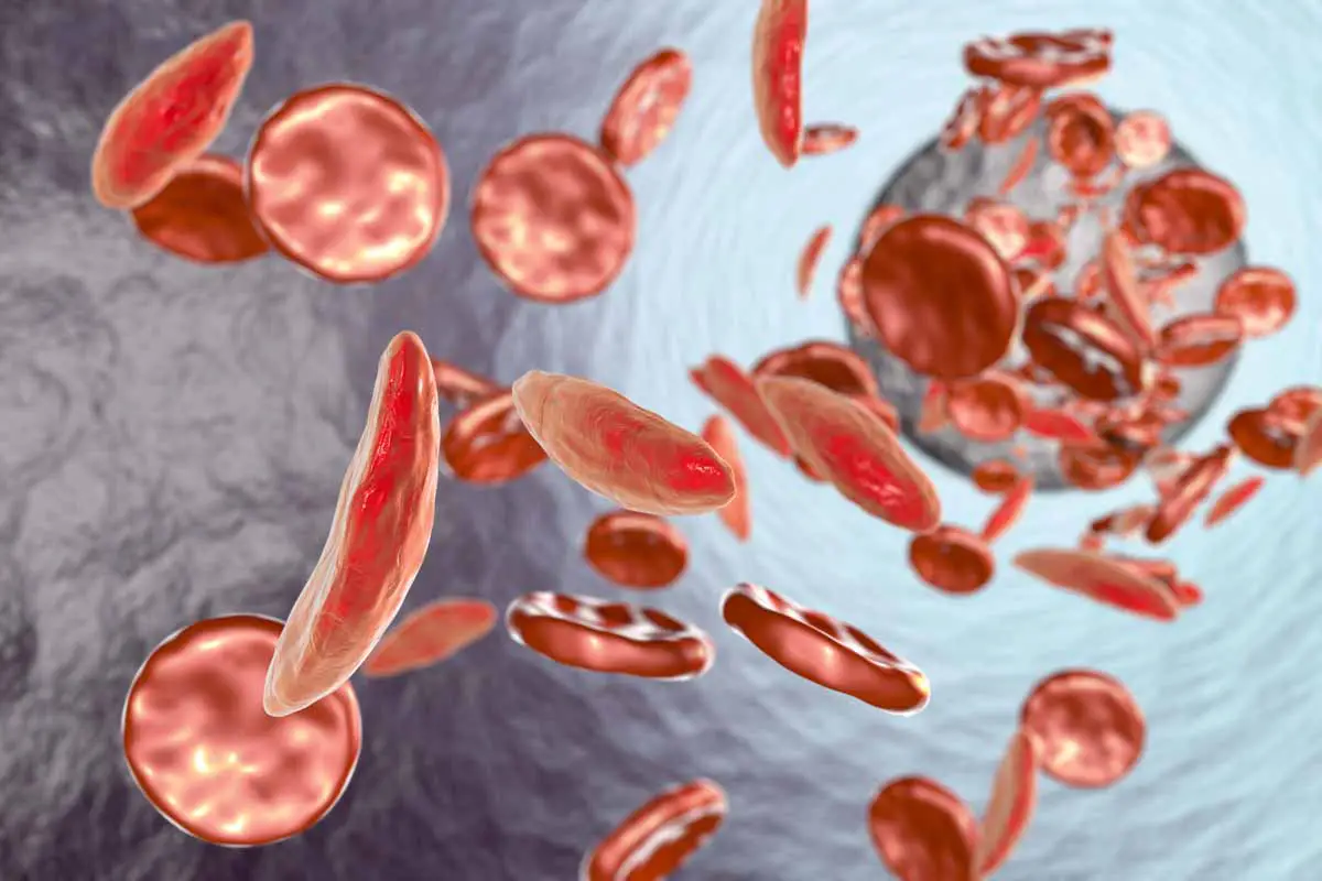 Aplasia Midollare Sintomi, Cause e Terapia dell'anemia aplastica