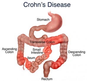 Malattia di Crohn