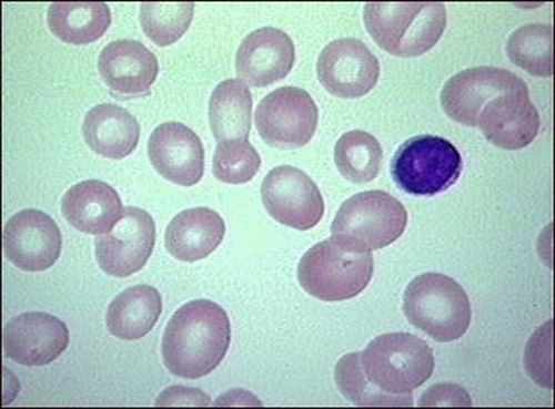 Anemia megaloblastica