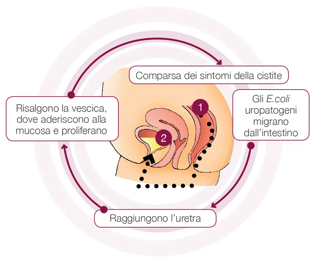 Cistite Cause e Sintomi