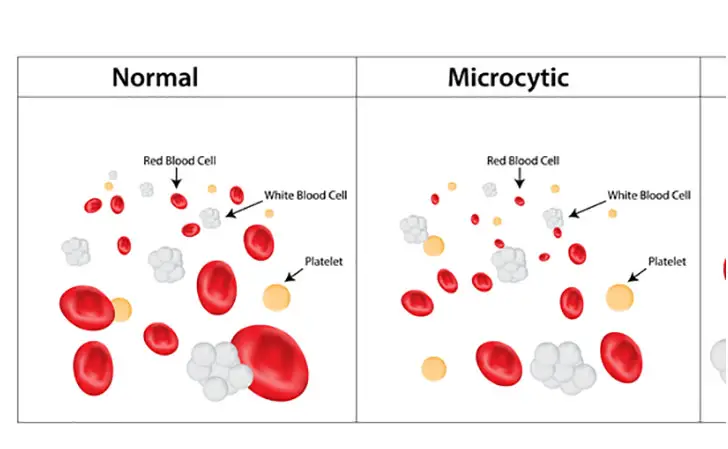 microcitosi